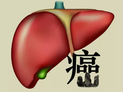 晚期肝癌最新疗法探索与研究